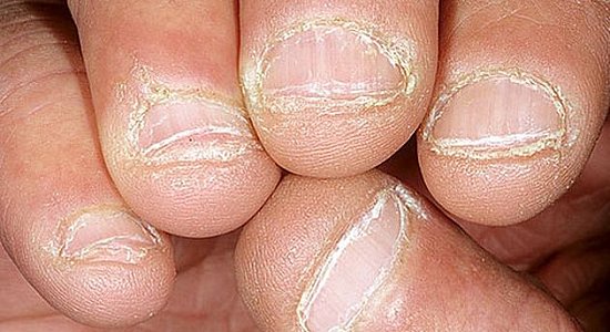 Наращивание - Обкусанные ногти Наращивание - Обкусанные ногти