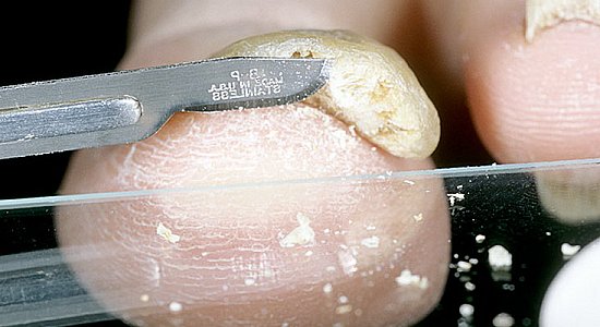 Лечение онихомикоза Лечение онихомикоза