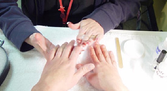 Симптомы грибкового заболевания ногтей