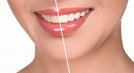 Лазерное отбеливание зубов – гарант успеха