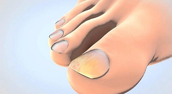 Защита ногтевой пластины от грибка