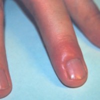 Простой герпес в области ногтевого валика