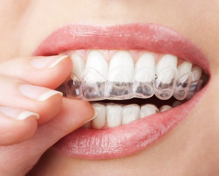 Полезная информация об отбеливании зубов (1)
