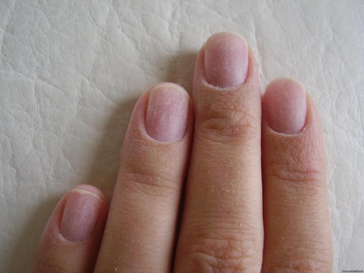 Как вернуть здоровье ногтям после снятия шеллака?1
