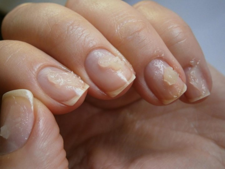 Как вернуть здоровье ногтям после снятия шеллака?3