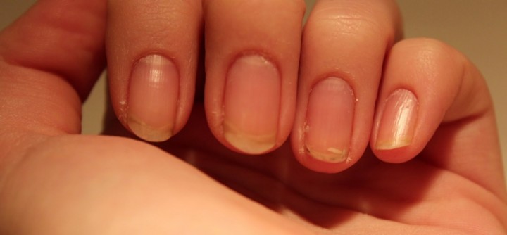 Ломкость ногтей – причины, лечение и профилактика2